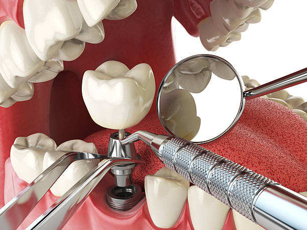 Best Emergency Dental Extractions in Mount Sterling, KY
